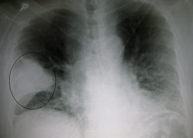 폐암환자들이 가장 조심해야하는 폐렴초기증상, 입원, 전염성