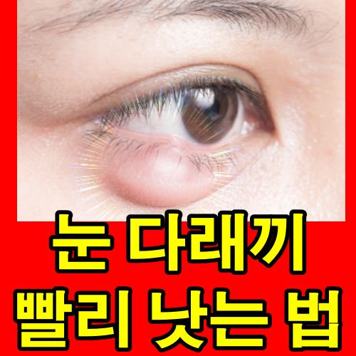 눈깜빡일때 통증의 원인과 대처법 (Causes And Solutions For Eye Blinking Pain)