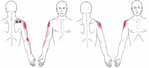 Shoulder Pain - Atx Orthopedics