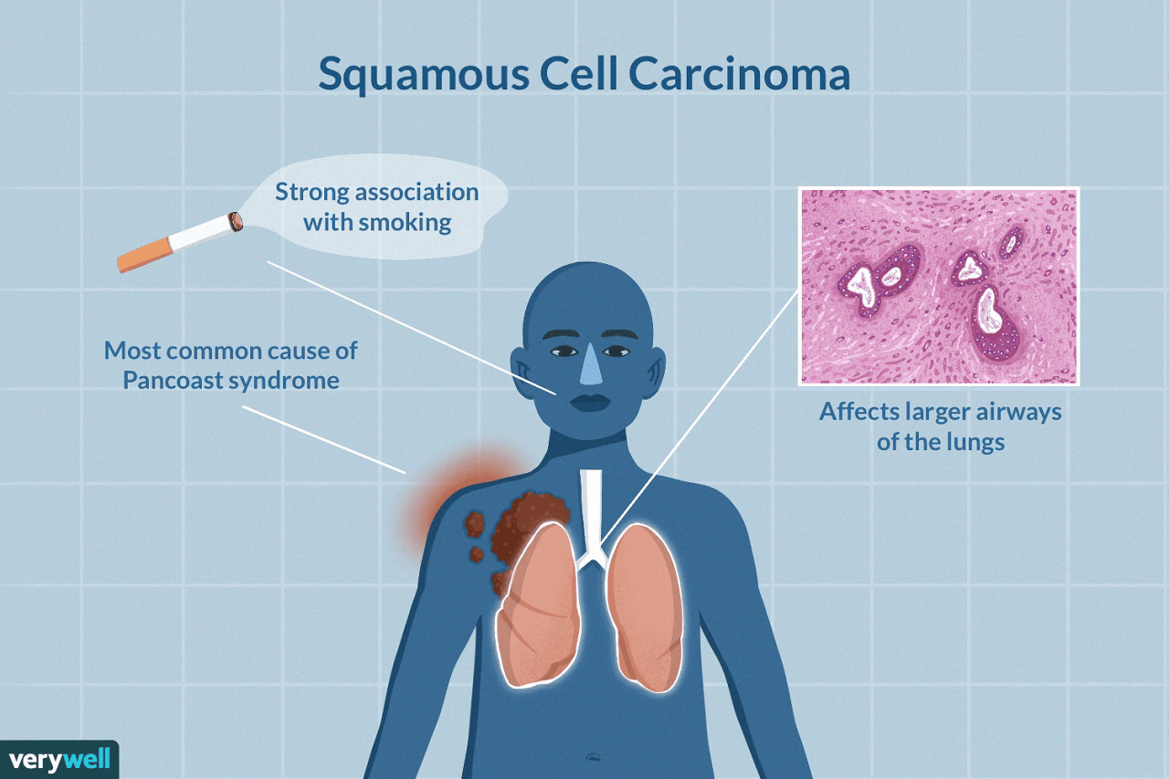 Squamous Cell Carcinoma In The Lungs: What To Know