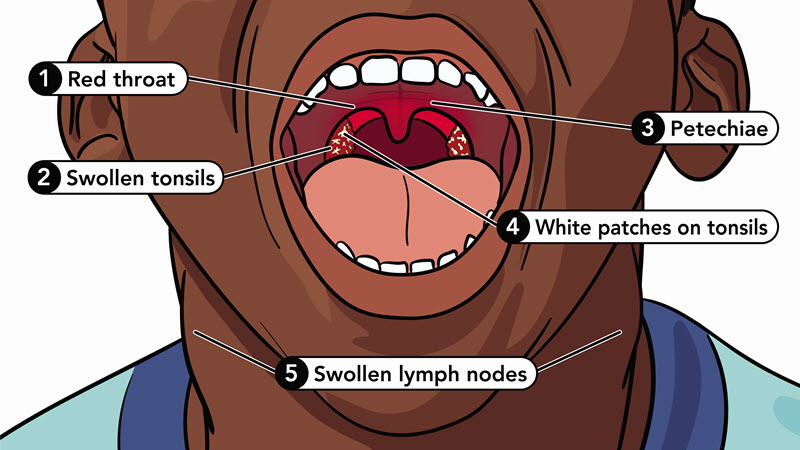 Strep Throat: All You Need To Know | Cdc
