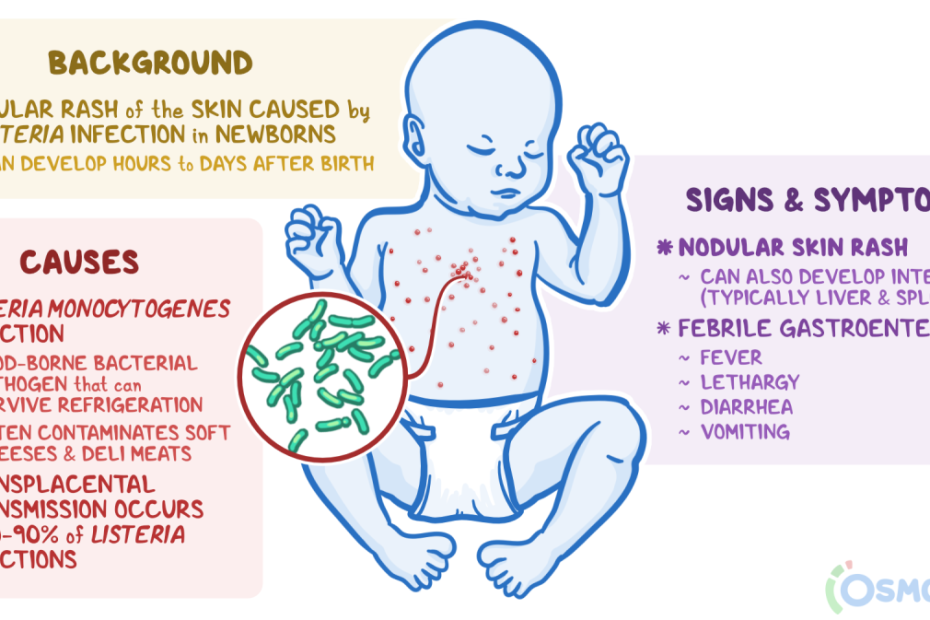 Granulomatosis Infantiseptica: What Is It, Treatment, And More | Osmosis